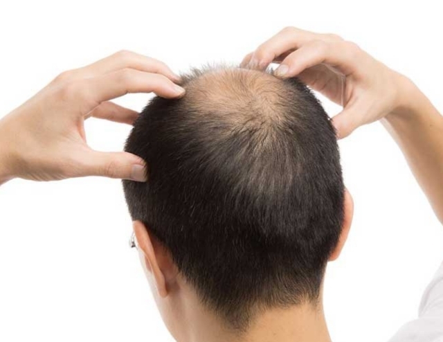 Hair transplant in Turkey 